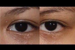 What Is The Best Way To Treat Syringoma Clinic in Abu Dhabi