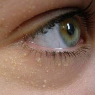 What Is The Best Way To Treat Syringoma in Dubai?