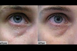 What Is The Best Way To Treat Syringoma in Dubai