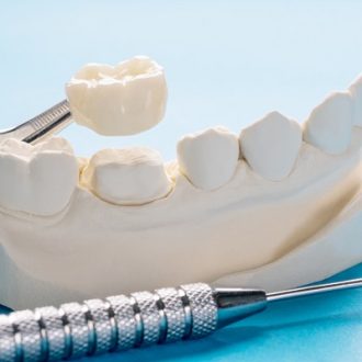 What To Know About Temporary Crowns in Dubai