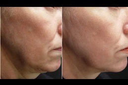 What Treatments Do Celebrities Use For Skin Tightening Clinic in Abu Dhabi