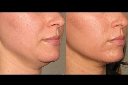 What Treatments Do Celebrities Use For Skin Tightening in Dubai