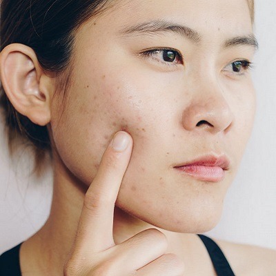 Acne Scars: Treatment Options And Prevention