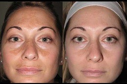 Are Lasers Safe To Use For Melasma in Dubai