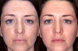 Best Are Lasers Safe To Use For Melasma in Dubai