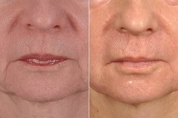 Best Dermapen Vs Traditional Micro-Needling; Which Is Right For You Clinic in Dubai & Abu Dhabi