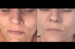 Best Dermapen Vs Traditional Micro-Needling; Which Is Right For You Clinic in Dubai