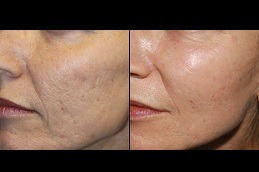 Best Dermapen Vs Traditional Micro-Needling; Which Is Right For You in Dubai