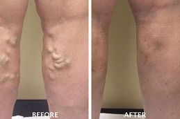 Best Sclerotherapy Effective Spider Veins Treatment Clinic in Dubai & Abu Dhabi