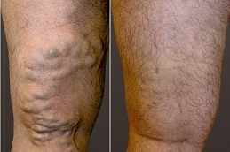 Best Sclerotherapy Effective Spider Veins Treatment Clinic in Dubai