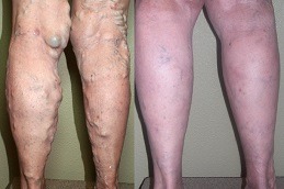 Best Sclerotherapy Effective Spider Veins Treatment in Dubai