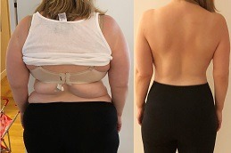 Best Weight Gain After Bariatric Surgery Facts And Solutions in Dubai