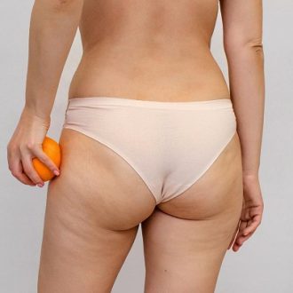 Can A Dermatologist Get Rid Of Cellulite?
