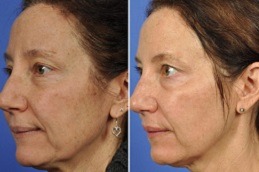 Dermapen Vs Traditional Micro-Needling; Which Is Right For You Clinic in Abu Dhabi