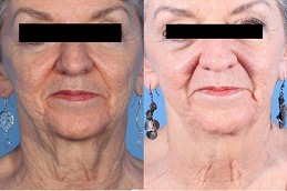 Dermapen Vs Traditional Micro-Needling; Which Is Right For You Clinic in Dubai & Abu Dhabi