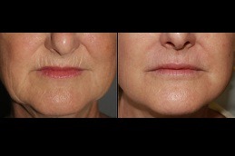 Dermapen Vs Traditional Micro-Needling; Which Is Right For You in Dubai
