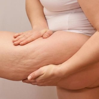 Does Liposuction Actually Remove Cellulite From Your Body?
