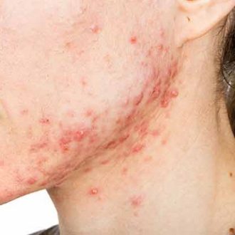 Hormonal Acne: Causes And Treatment Strategies