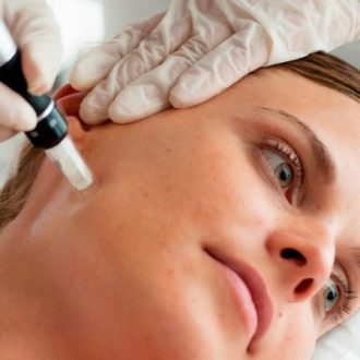How Dermapen Micro-Needling Can Improve Skin Texture And Tone?