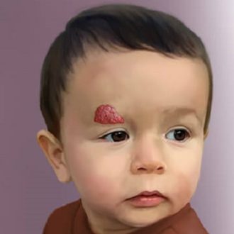 Laser Treatment For Hemangioma In Infants Dubai