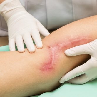 Laser Treatments For Surgical Scars in Dubai
