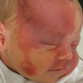 Port-Wine Stain Removal For Infants in Dubai