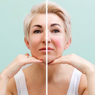 Rosacea Vs Acne: How To Tell The Difference & Treat Them