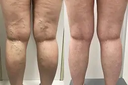 Sclerotherapy Effective Spider Veins Treatment Clinic in Abu Dhabi