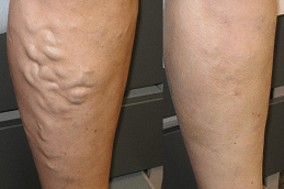 Sclerotherapy Effective Spider Veins Treatment Clinic in Dubai & Abu Dhabi