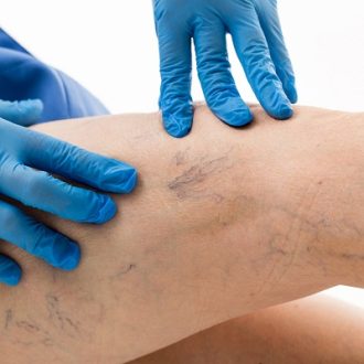 Sclerotherapy: Effective Spider Veins Treatment