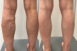 Sclerotherapy Effective Spider Veins Treatment in Dubai