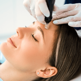 The Benefits Of Dermapen Microneedling For Acne Scarring