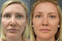 Types Of Stem Cell Therapy - An Overview in Dubai