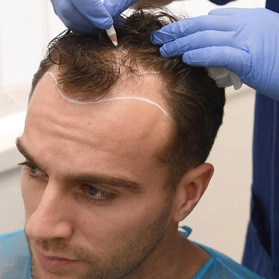 Unveiling The Power Of The FUE (Follicular Unit Extraction) Technique