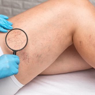 What Are The Stages Of Varicose Veins in Dubai?