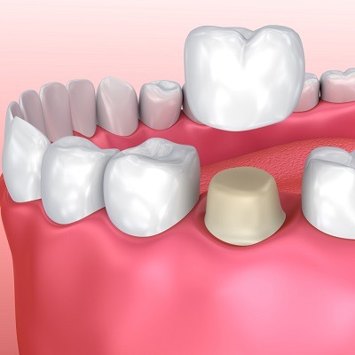 What Is an Abscessed Tooth in Dubai & Abu Dhabi?