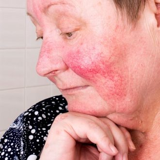 When To See A Dermatologist For Rosacea Treatment?