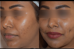 Which Celebrities Had DimplePlasty Clinic in Abu Dhabi