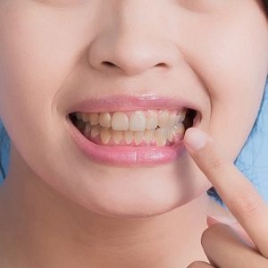 Yellow Teeth: Causes And How To Whiten Teeth