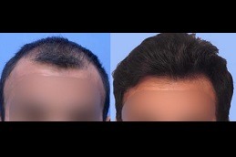 unveiling the power of the fue follicular unit extraction technique Clinic in Abu Dhabi