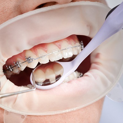 7 Reasons Why You Should Opt For Ceramic Braces