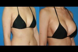 AFT Breast Augmentation in Dubai