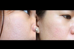 Acne Scar Treatment with Fractional CO2 Laser Clinic in Abu Dhabi