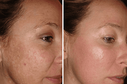 Acne Scar Treatment with Fractional CO2 Laser Clinic in Dubai & Abu Dhabi
