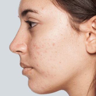 Acne Scar Treatment with Fractional CO2 Laser
