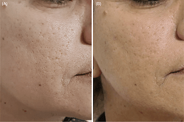 Acne Scar Treatment with Fractional CO2 Laser in Dubai