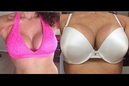 Best AFT Breast Augmentation Clinic in Dubai & Abu Dhabi