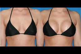 Best AFT Breast Augmentation Clinic in Dubai