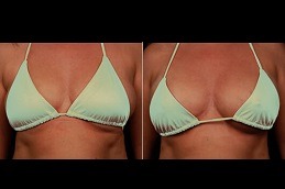 Best AFT Breast Augmentation in Dubai