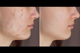Best Acne Scar Treatment with Fractional CO2 Laser Clinic in Dubai & Abu Dhabi